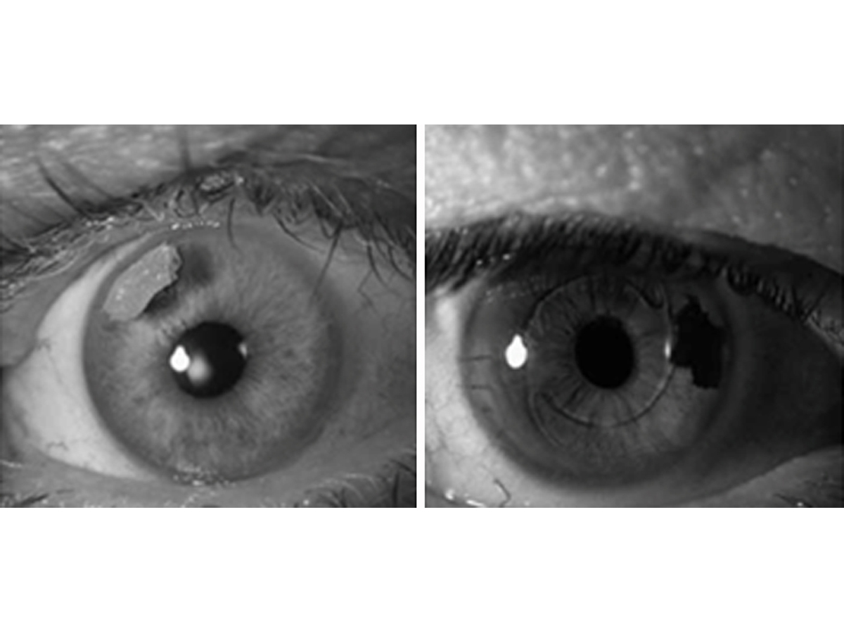 I would like to perform corneal tattooing on patients with iris  abnormalities Does OMIC cover this activity  OMIC